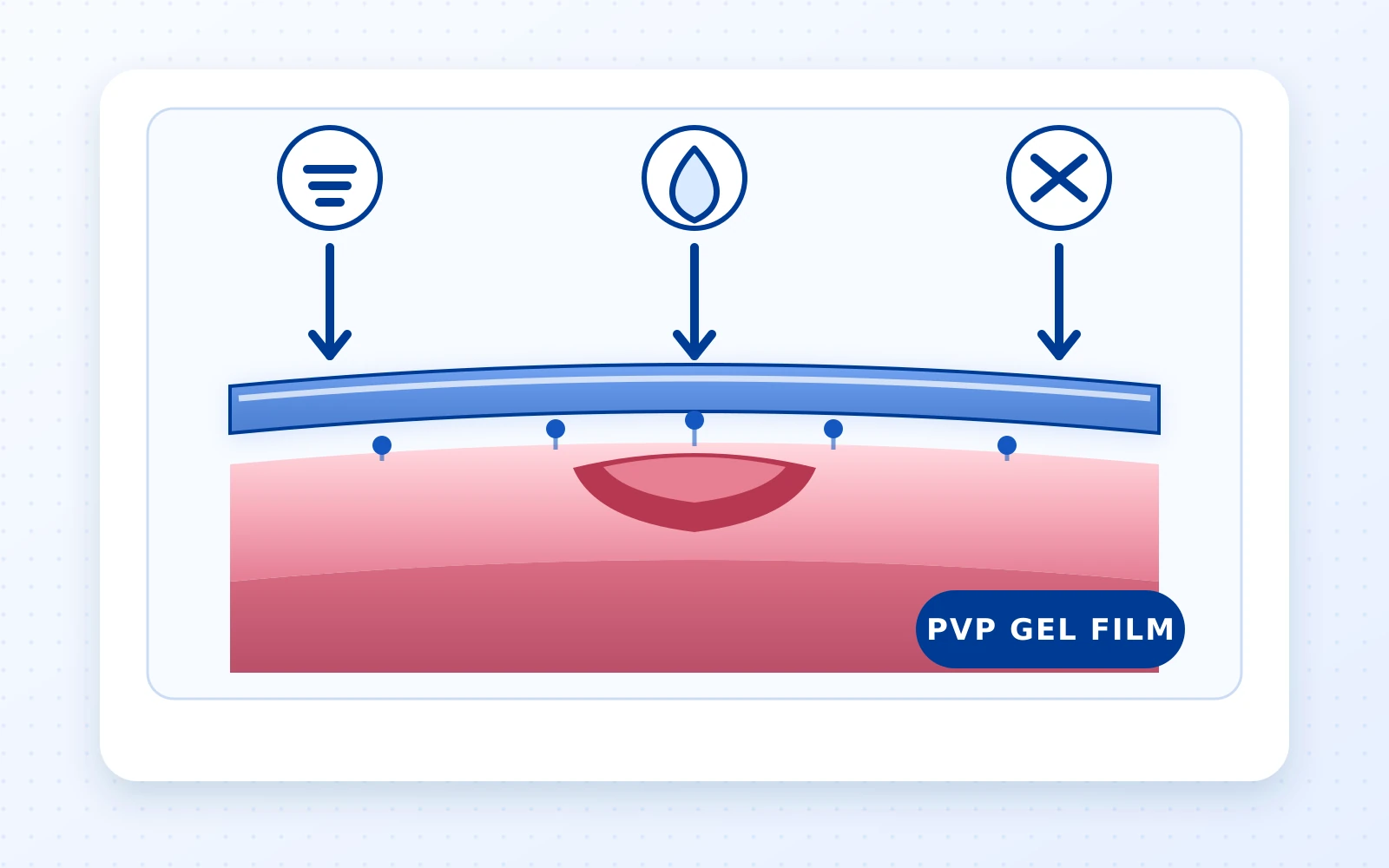 ภาพกลไกฟิล์ม PVP Gel เคลือบเหนือเยื่อบุช่องปากที่บอบบาง ช่วยลดการสัมผัสโดยตรงจากอาหาร น้ำ และแรงเสียดสี
